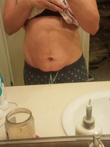 Diastasis Recti Repair surgery journey. Day before my surgery to fix my still pregnant look and non functioning core!