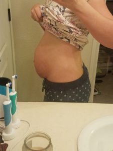 Diastasis Recti Repair surgery journey. Before picture, after picture in the next post!