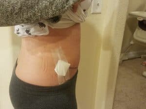 My Diastasis Recti 1 week after surgery