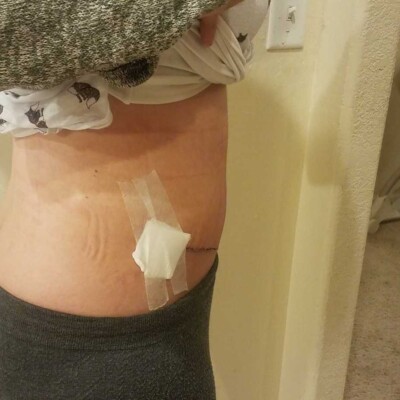 My Diastasis Recti 1 week after surgery